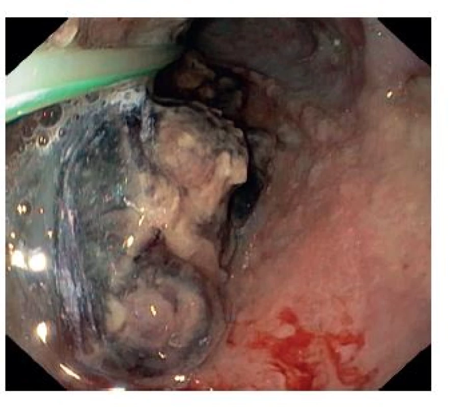 Gastroskopický snímek po 7 dnech s prolabujícím hematomem
Fig. 2: Upper endoscopy image after 7 days with obturating haematoma