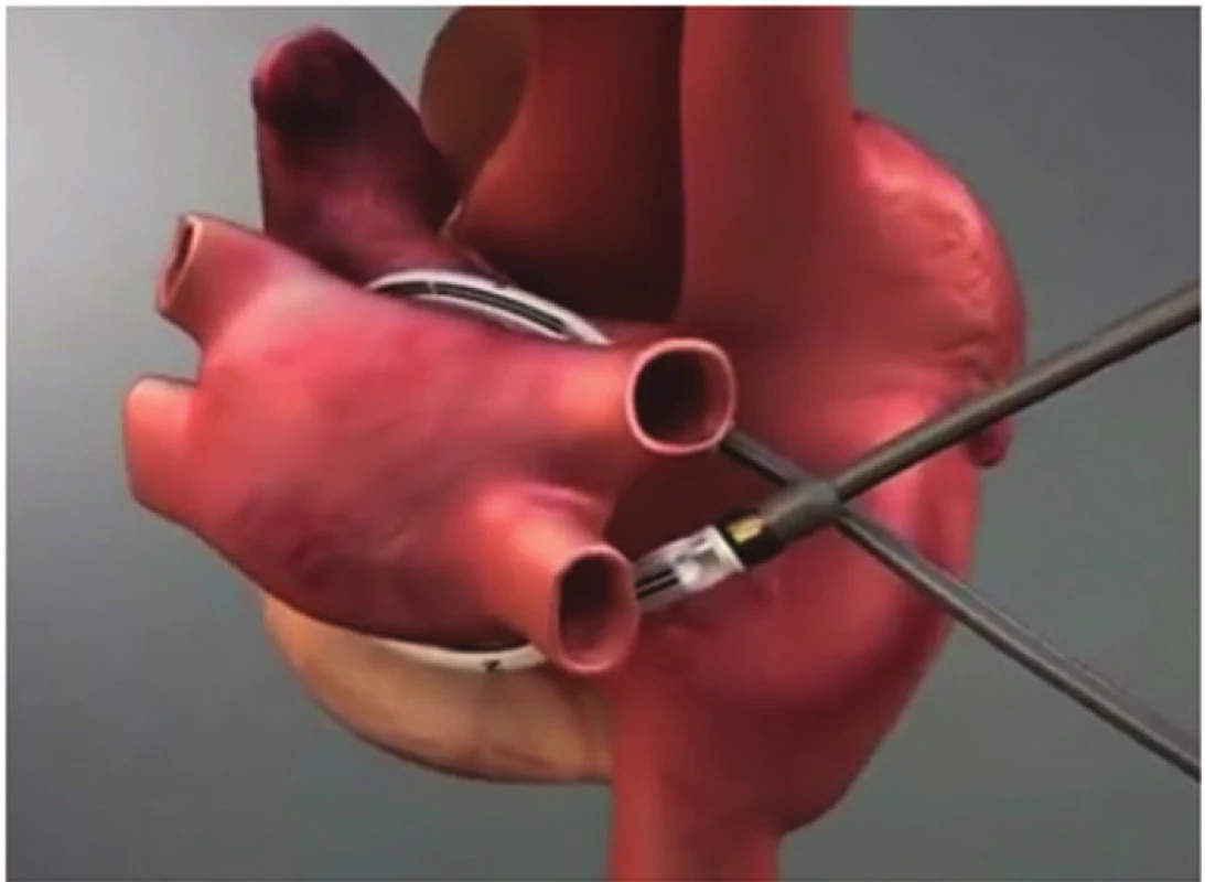 Schéma umístění ablační sondy kolem plicních žil
Fig. 1: Position of the catheter around pulmonary veins