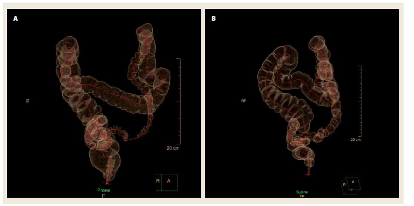 Distenze tračníku. Částečně kolabované sigma v poloze na břiše (A), plně distendované sigma v poloze na zádech u téhož pacienta (B).
Fig. 4. Colonic distension. Partially collapsed sigmoid colon in prone position (A), fully distended sigmoid colon in supine position (same patient) (B).