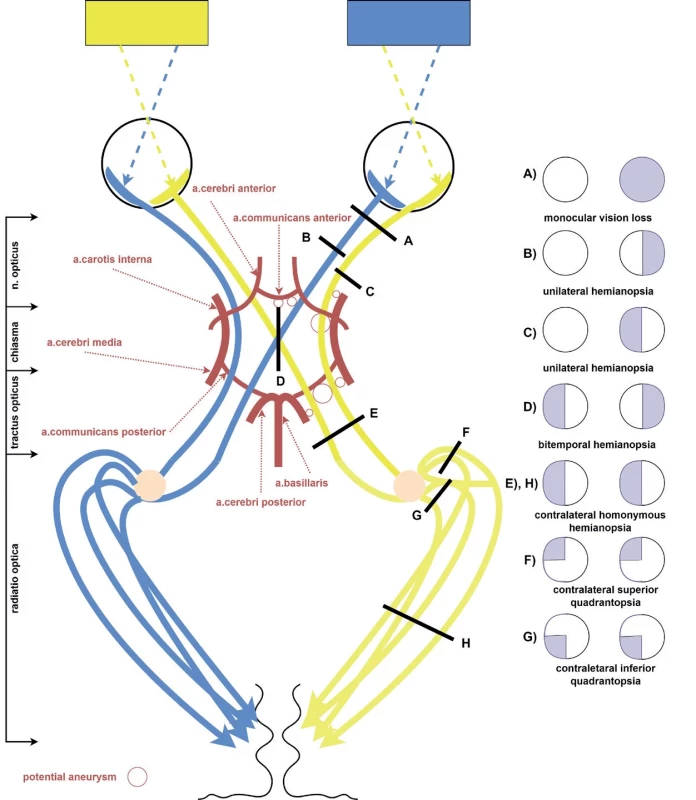 The schematic illustration of the relationship of the visual pathway with the intracranial circle of Willisi, the potential localization of aneurysms (marked with a red circle) and their place of compression with the corresponding visual field defects