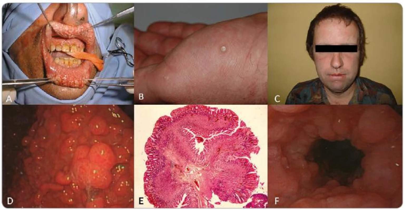 Pacient 1: A – rozsiahla papilomatóza pier, B – akrálne keratózy, C – makrocefália, D – polypóza žalúdka, E – histologický preparát hyperplastického polypu žalúdka, F – glykogénna akantóza.