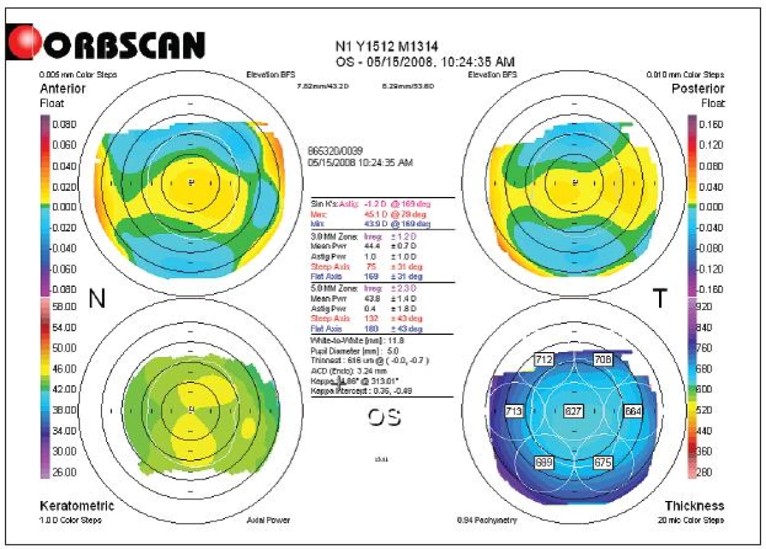 Topografické vyšetření oka levého před operací Lasik