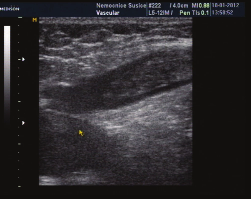Zobrazeni pahýlu trombu v kmeni VSM
Fig. 10: Image of thrombus in the trunk of the GSV