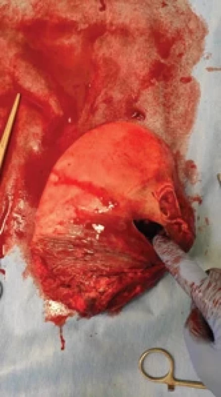 Spontánní perforační otvor odstraněné dělohy. Fig. 2. Spontaneous perforation of the removed uterus.
