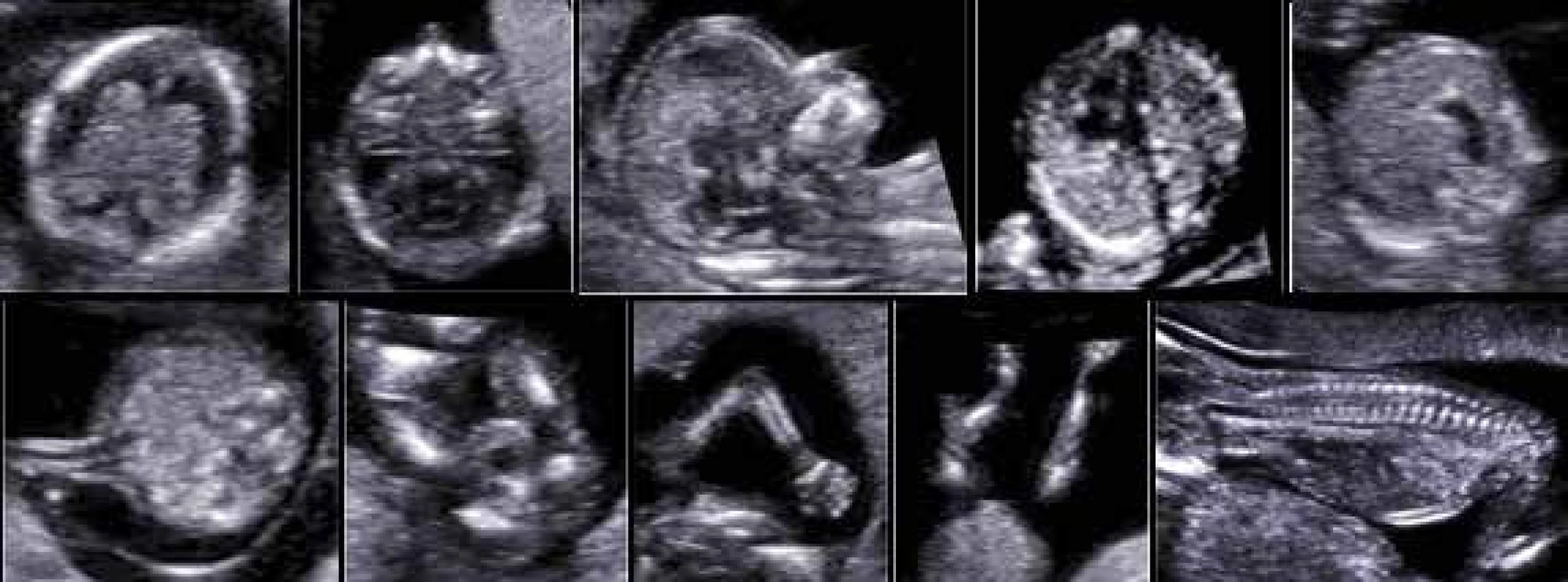 Ultrasonografické vyšetření morfologie plodu v 1. trimestru dle ISUOG a FMF doporučení (normální nálezy)