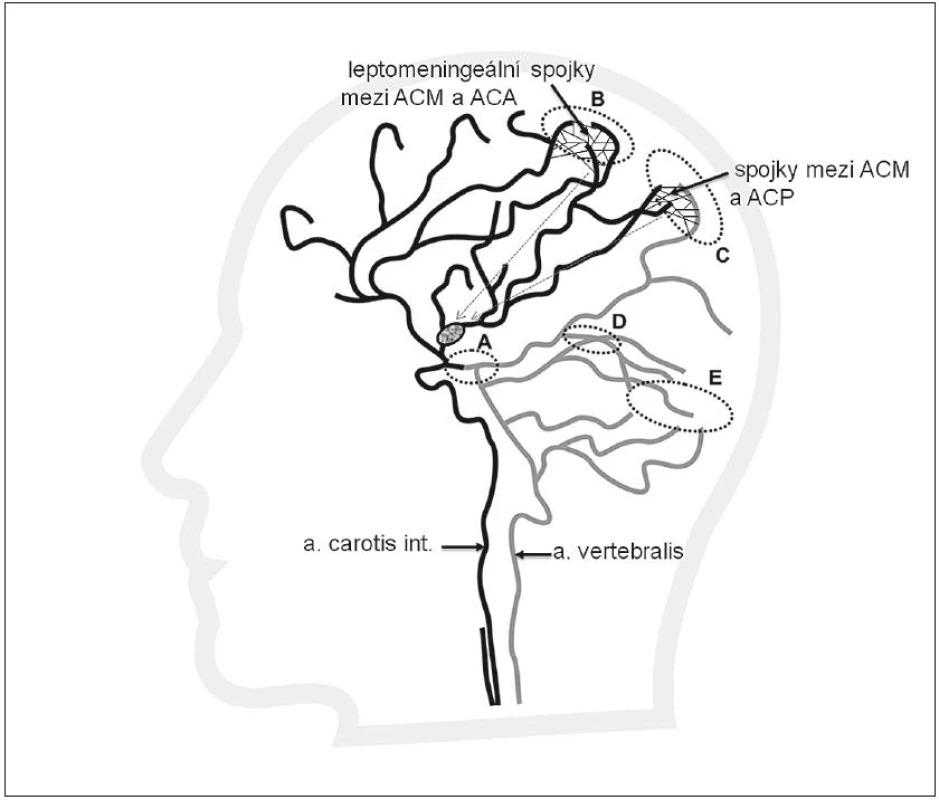 Výborně vytvořené leptomeningeální kolaterály mezi povodím ACM a ACA (B) a mezi ACP (šedá) a ACM (C), které přivádějí krev do leptomeningeálních kolaterál v pia mater (tenké černé linie). Kolaterály zajišťují retrográdní plnění (šipky) větví při trombu v ACM z povodí ACA a ACP. Plnění je patné na CTA jako retrográdní náplň k distální části trombu.