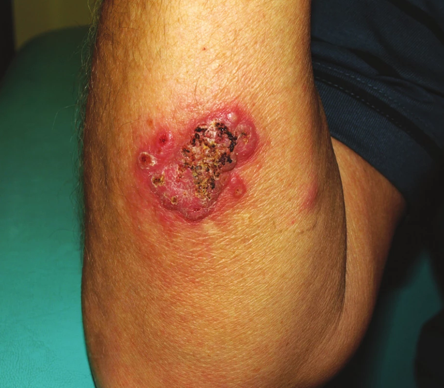 Pyoderma gangrenosum.