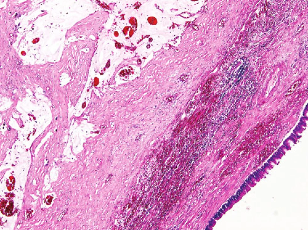 Kolekce hlenu ve stěně appendixu pod dysplastickým luminálním epitelem (HE, 48x)
Fig. 2. Collection of phlegm in the appendiceal wall below its dysplastic epithelium (HE, 48x)