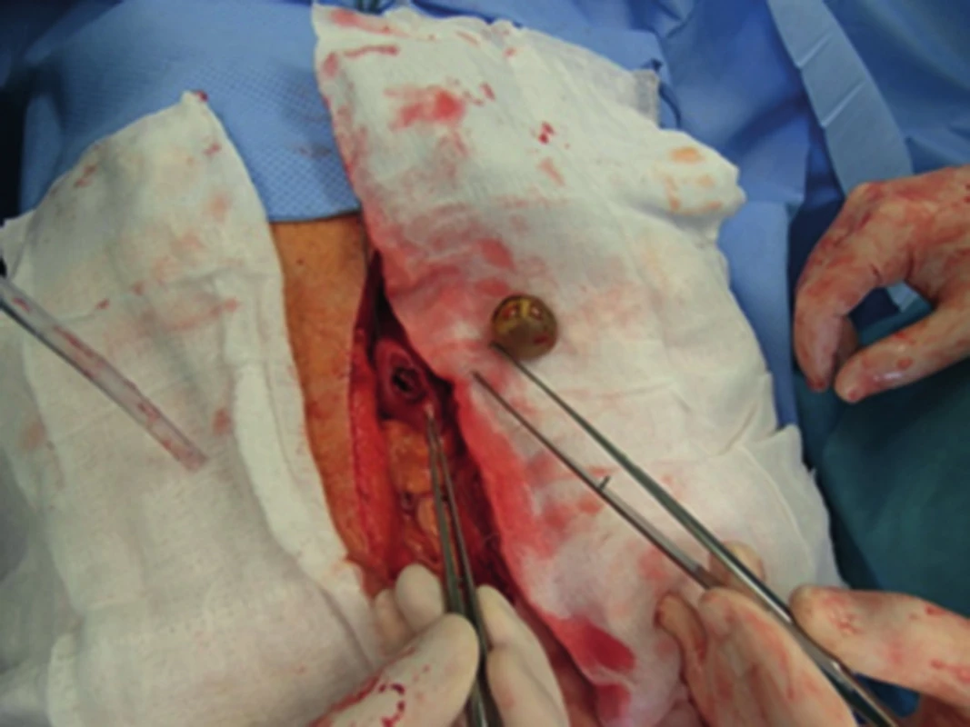 Extrahovaný konkrement z gastrotomie
Fig. 4: Gallstone extracted from gastrotomy