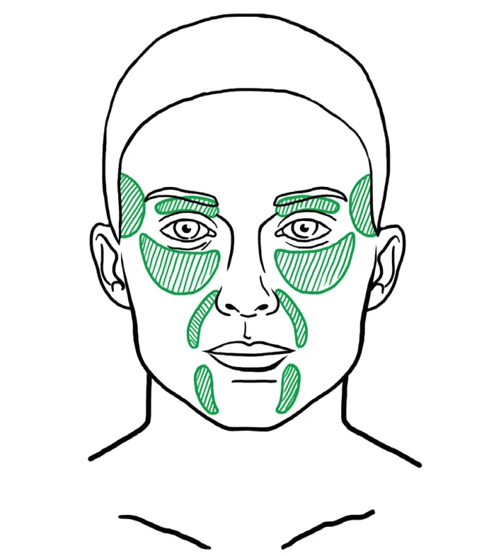 Areas that usually need deep filling with fat during facial fat grafting