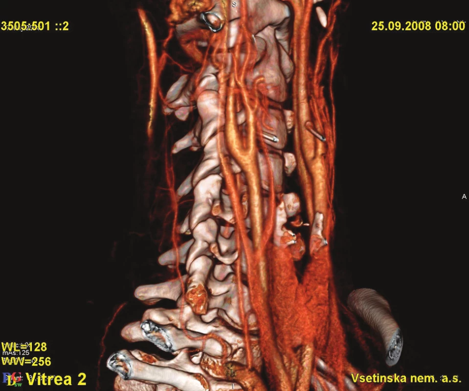 Kompletní rekanalizace ACI vpravo 
Fig. 5. Complete recanalization of the right ACI