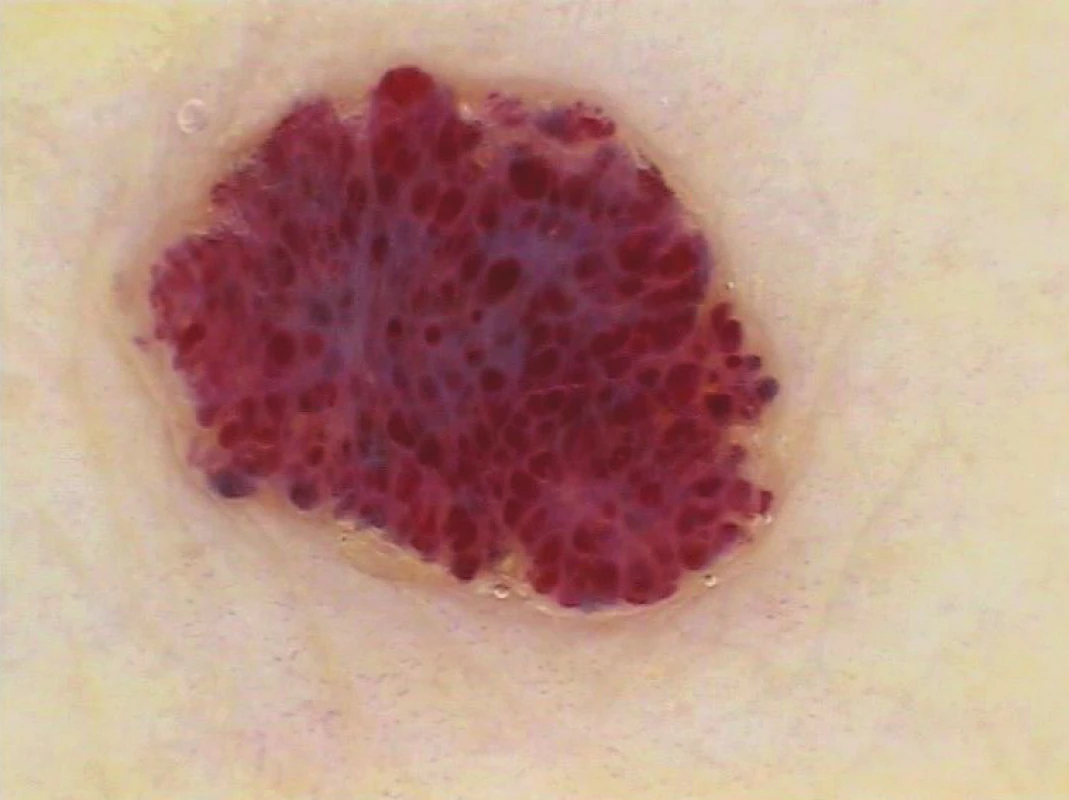 Hemangiom