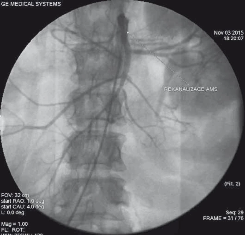 Kontrolní angiografie po zavedení dvou stentů do oblasti horní mezenterické tepny 
s dosažením úplné rekanalizace tepny.