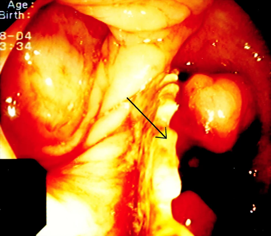 Síťka v lumen střeva
Fig. 2. The mesh within the intestinal lumen