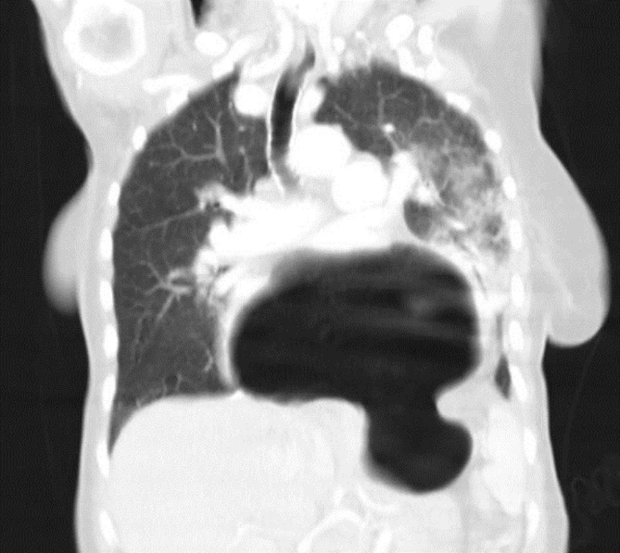 Frontální snímek CT
Fig. 10: Frontal CT image