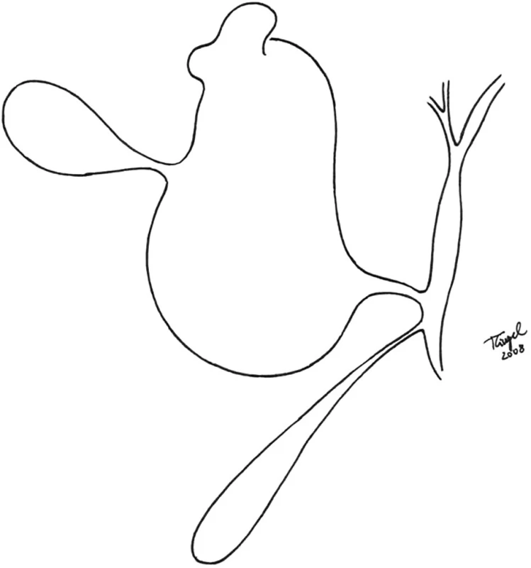 Schématické znázornenie operačného nálezu
Fig. 4. Scheme of operative finding