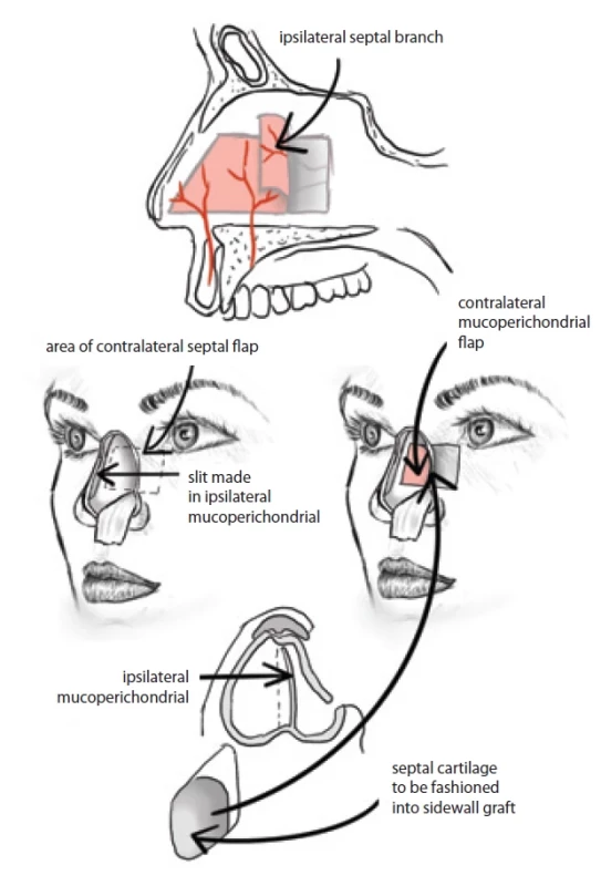 Ipsilateral and contralateral septal fl ap in mid-nasal reconstruction. (Drawing by A. Berkeš according to [2]).