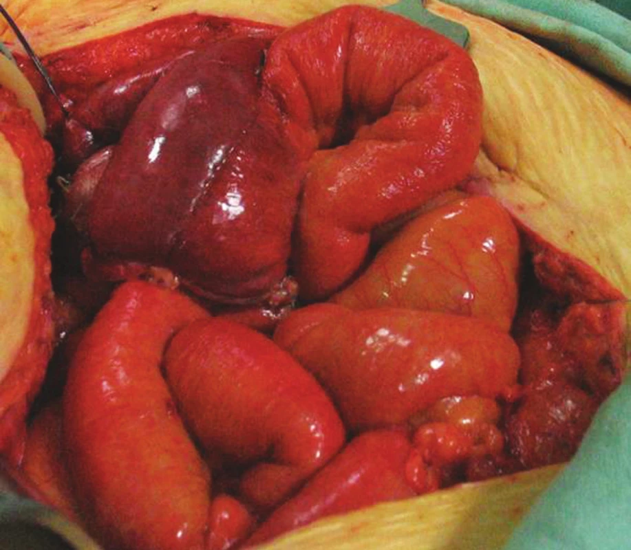 Kazuistika III – Suspektně ischemická klička exkludovaného ilea (neoveziky)
Fig. 7. Case report III – Suspect ischemic segment of excluded part of ileal bowel (neovesica)