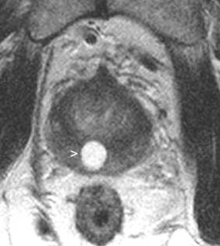 Cysta utriculus prostaticus.