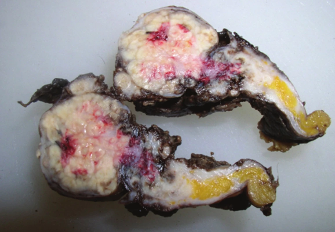 Hnisavě změněné levé ovarium s tubou na řezu
Fig. 4: Suppuratively changed left ovary with a salpinx on the cut