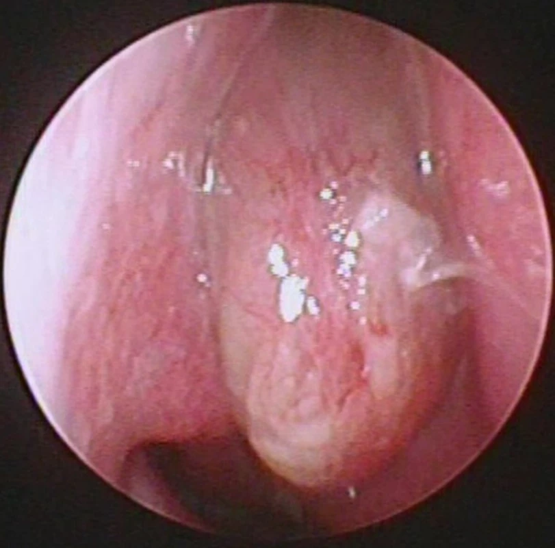 Polyp nosní dutiny vpravo dosahující až hranice kaudální hrany dolní skořepy