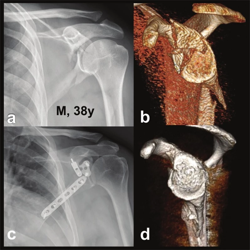 Reconstruction of glenoid fossa (Pt – 4)
