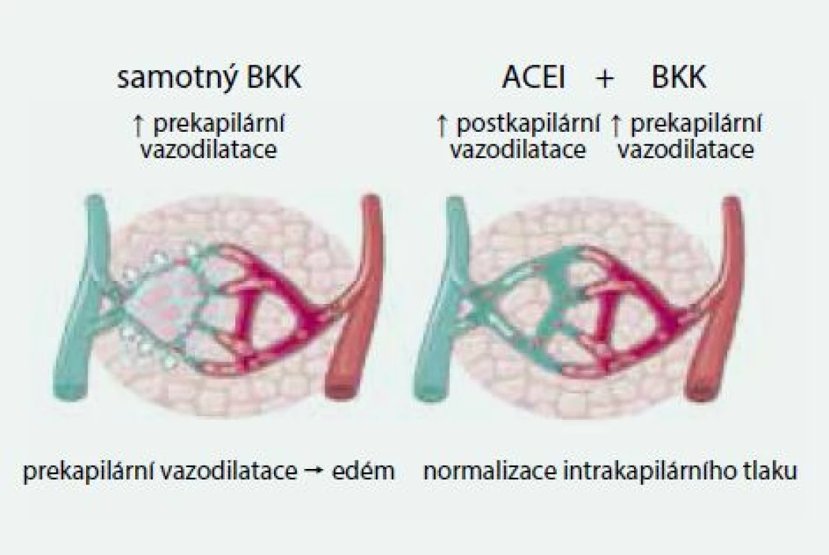 Mechanizmus účinku ACE inhibitorů na snížení otoků po kalciových blokátorech