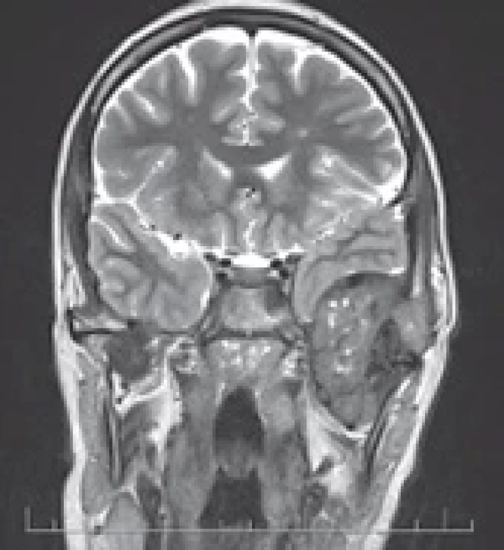 Pre-operative MRI – fi rst case.