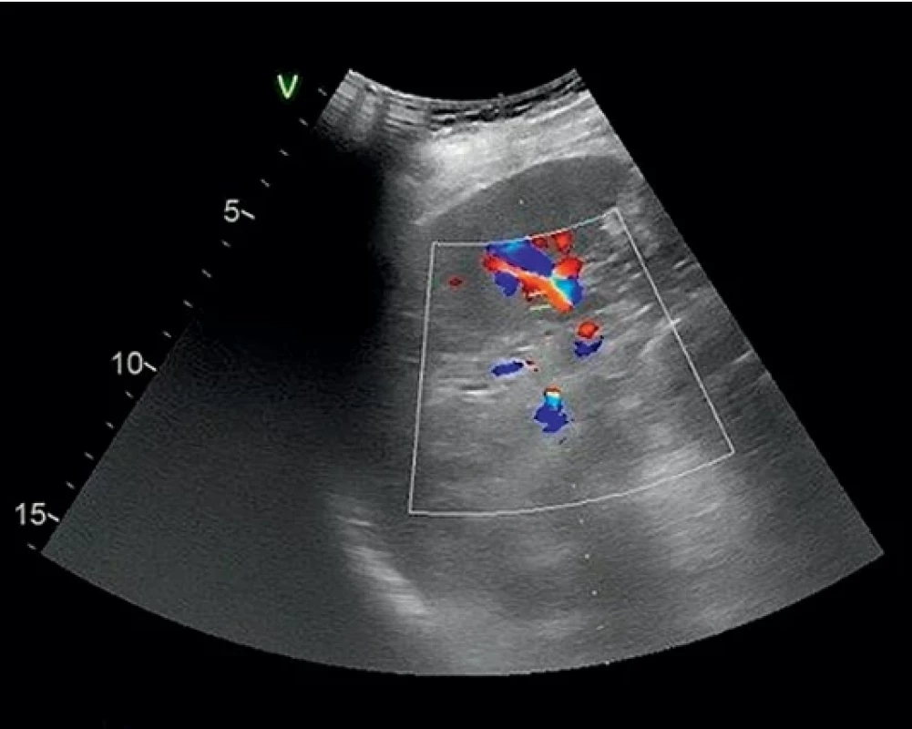 Kontrolní ultrazvukové vyšetření prvního pacienta.  Control ultrasound examination of the first patient.