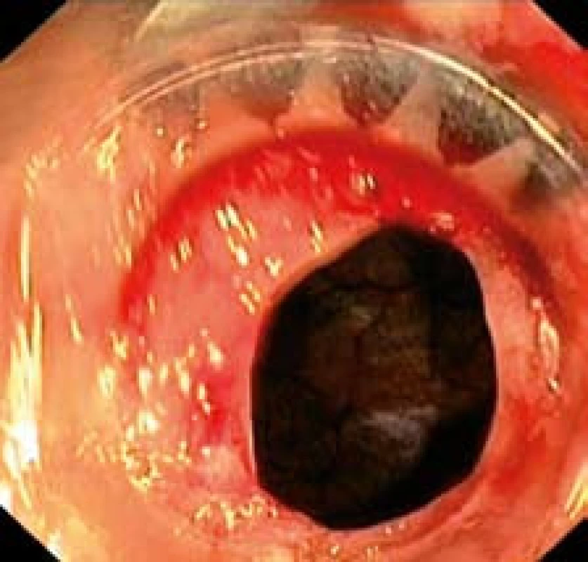 Nasazený OT SC<sup>®</sup> klip a nasátí perforace do capu.
Fig. 3. OTSC<sup>®</sup> applied, perforation sucked into a cap.