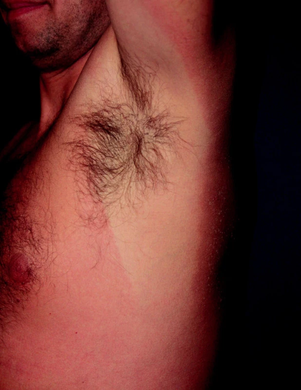 Erythema solare.