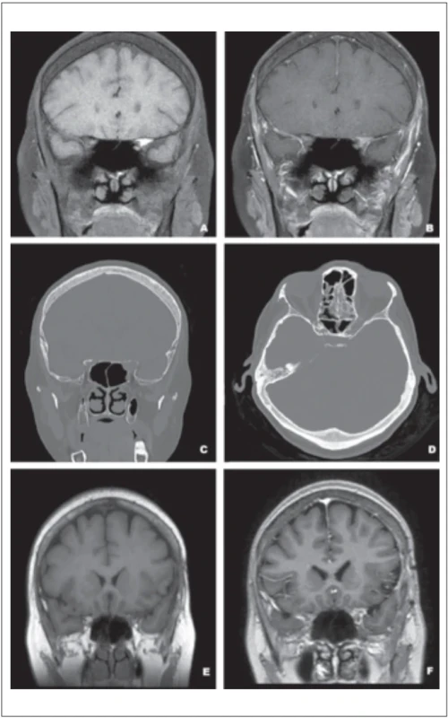 Vstupné vyšetrenie MR-T1 vážený natívny (A) a s postkontrastný obraz (B) v koronálnej rovine zobrazuje hyperintenzívne lézie v oboch proc. clinoideus anterior zvýrazňujúce sa po podaní kontrastnej látky. Vstupná CT v axiálnej (C) a koronálnej (D) rovine zobrazuje pneumatizáciu proc. clinoideus anterior bilaterálne vrátane uzurácie kostnej steny ľavostranného optického kanála. Pooperačná MR v natívnom (E) a postkontrastnom (F) T1 vyšetrení zobrazujúce regresiu ľavostrannej mukokély. Fig. 1. Initial MRI examination – T1 weighted native (A) and contrast-enhanced image (B) in coronal plane depicting hyperintense lesions in both anterior clinoid processes enhancing after administration of contrast medium. Initial CT in axial (C) and coronal (D) plane depicting pneumatisation of bilateral anterior clinoid processes with erosion of bony margins of the left-sided optic canal. Postoperative MRI in T1 native (E) and contrast-enhanced (F) sequence display regression of a left-sided mucocele.