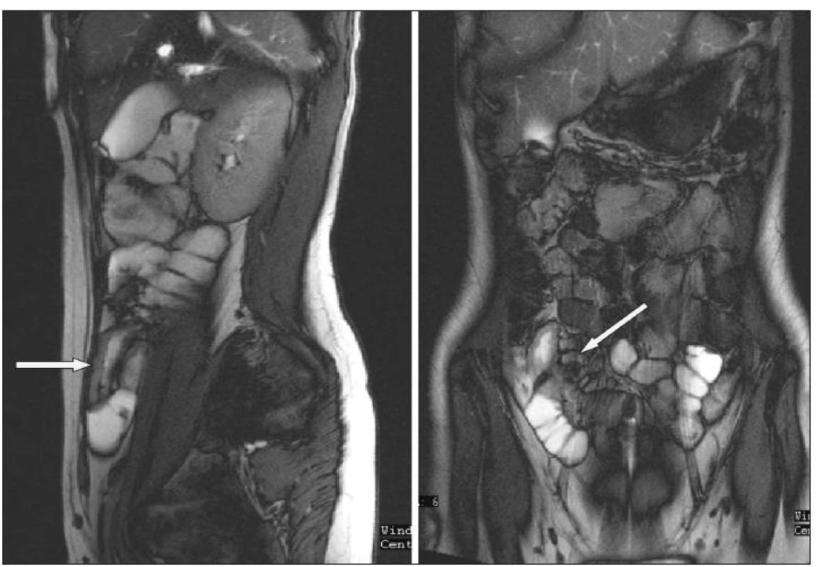 MR enterografie – zesílení terminálního ilea a zvětšené uzliny v mezenteriu
Fig. 6. MRI enterography –thickening of the terminal ileum and enlarged mesenteric lymph nodes