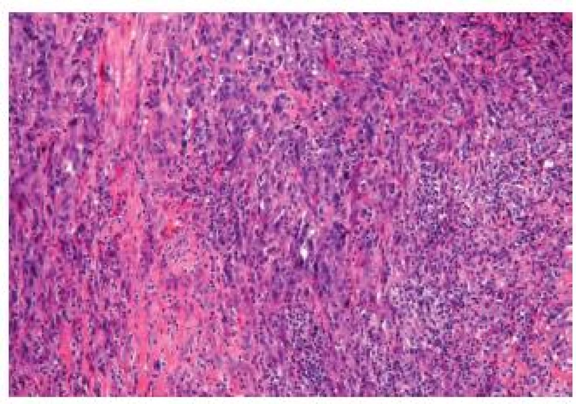 Sarcomatoid carcinoma. Poorly differentiated appearance, the tumor cells are fusiform.
