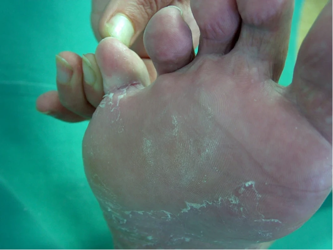 Tinea pedum – vezikuly, deskvamace