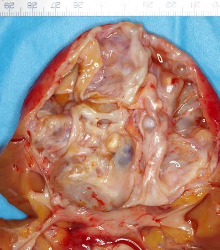 <i>Smíšený epiteliální a stromální tumor ledviny</i>
Fig. 4. <i>Mixed epithelial and stromal tumour</i>