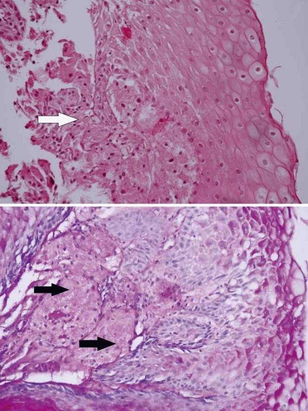 Histologický obraz granularnobunkového tumoru u prezentovaného pacienta – granulárnobunkový tumor pažeráka (šípka) tvorili skupiny buniek s objemnou zrnitou eozinofilnou cytoplazmou (A) s malými ovoidnými hyperchrómnymi jadrami a s PAS (periodic acid schiff ) pozitivitou (B). 
Fig. 3. Histology of granular cell tumour in the presented patient – oesophageal granular cell tumour (arrow) consisted of nests of cells with sizeable granular eosinophilic cytoplasm (A) with small ovoid hyperchromatic nuclei with PAS (periodic acid-Schiff ) positivity (B). A. haematoxylin/eosin ×200; B. PAS ×200.