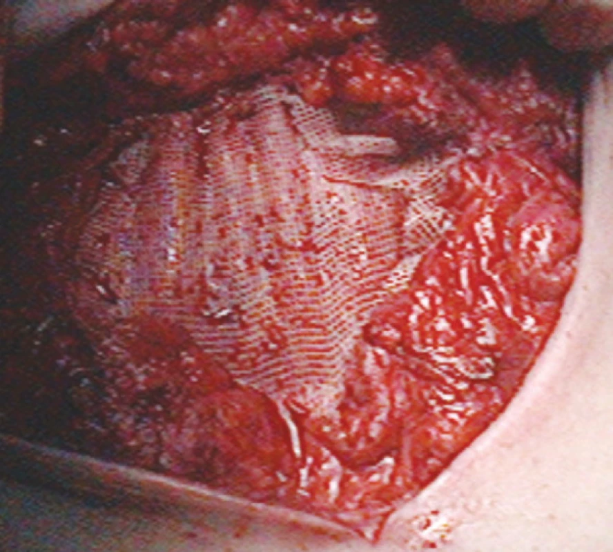 Fixace síťky
Fig. 8. Mash fixation