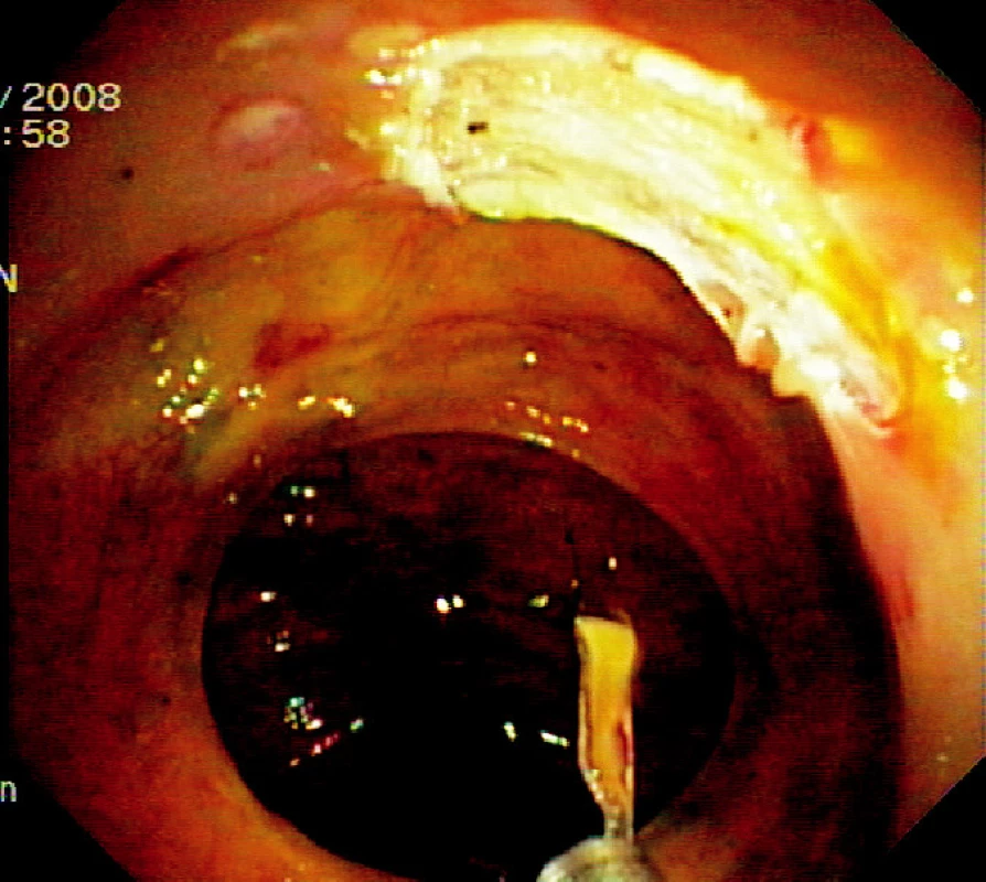 Spodina po endoskopické slizniční resekci
Pic. 3. The base after endoscopic mucosal resection