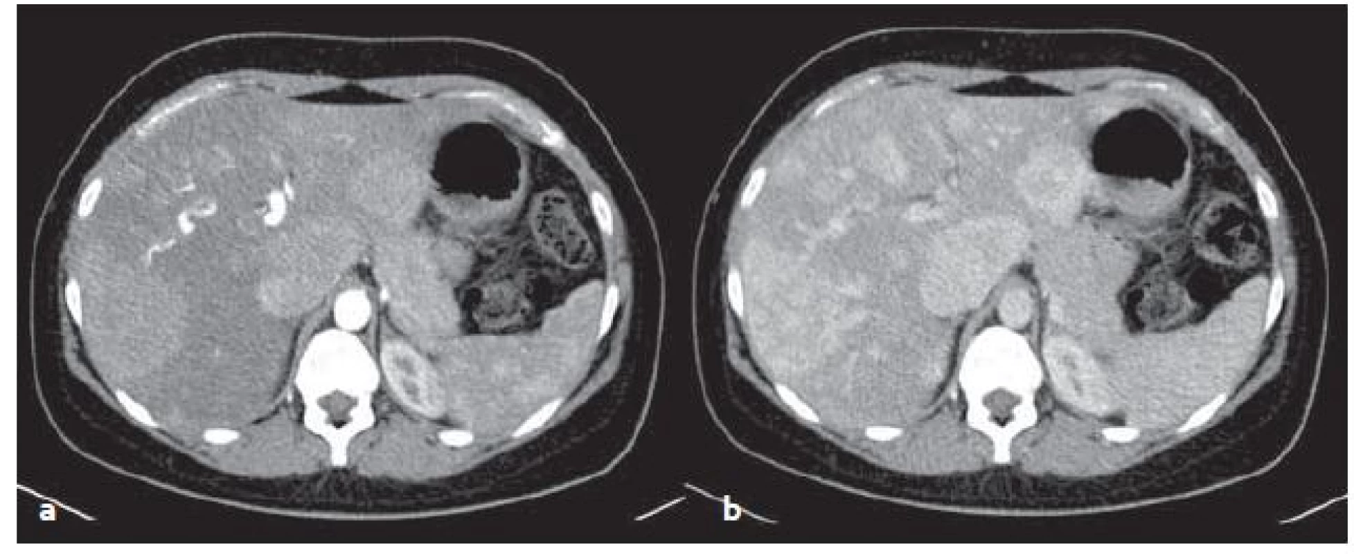 CT vyšetření – mnohočetné zánětlivé adenomy v arteriální (a) a venózní (b) fázi. Sytí se v arteriální fázi, ve venózní fázi sycení přetrvává.
Fig. 4. CT scans – multiple inflammatory adenomas in arterial (a) and venous (b) phase. Adenomas feed contrast medium in the arterial phase, in venous phase saturation persists.