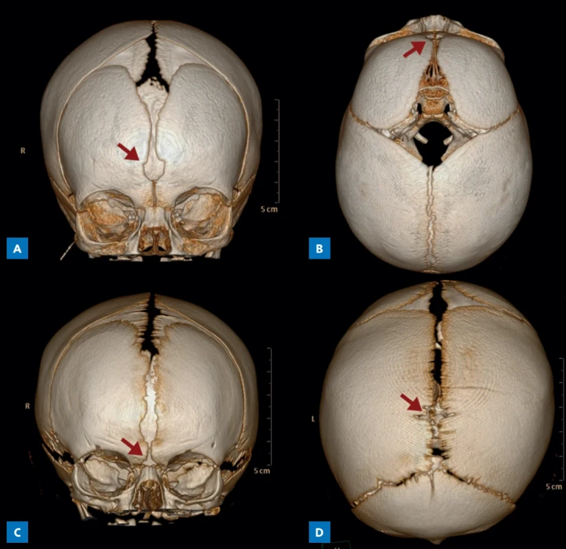 Príklady akcesórnych fontanel na 3D CT rekonštrukciách lebky pacientov s normocefáliou. A, B – metopická fontanela; C – glabelárna fontanela; D – parietálna fontanela v oblasti obelion. (Archív KDCH)
