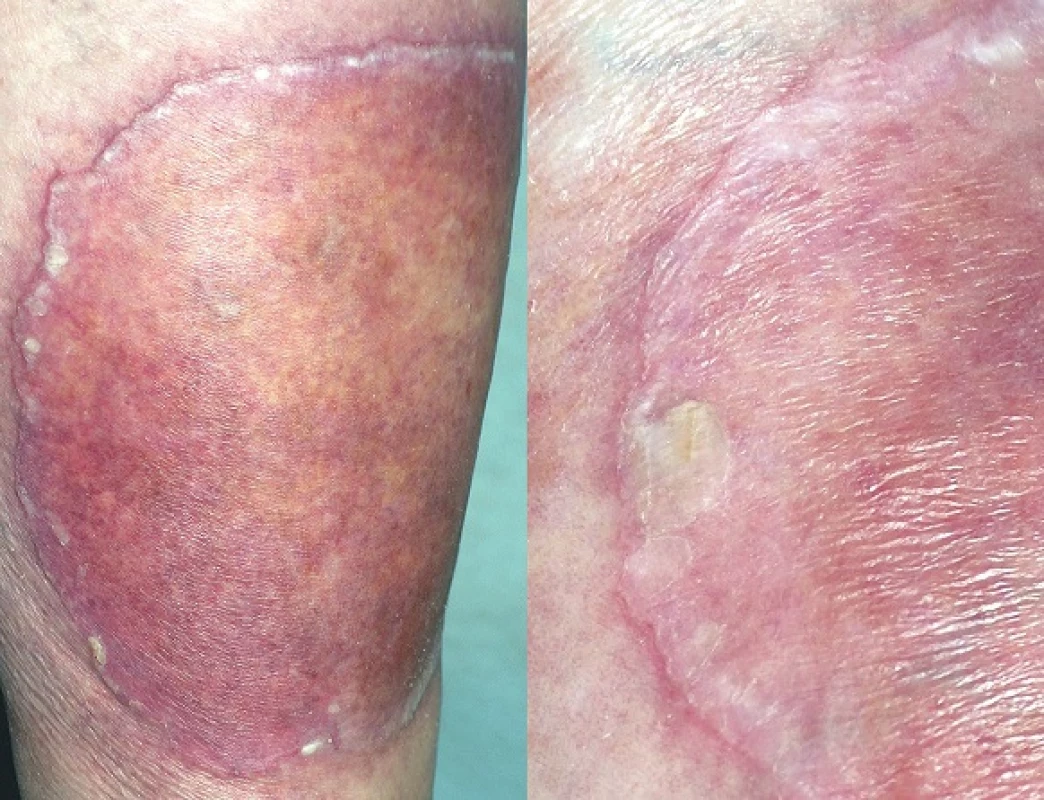 Porokeratosis Mibelli gigantea
V detailu s patrným tzv. periferním vláskovým lemem a atrofií kůže centrálně.