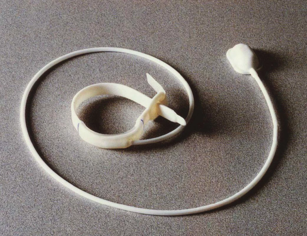 Lap-Band – původní verze
Fig. 1. Lap-Band – old version