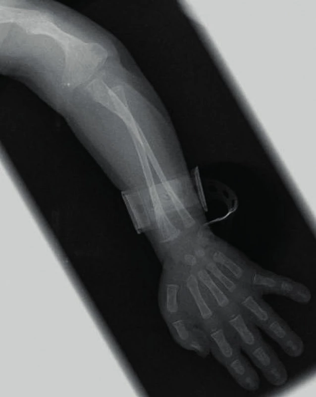Dítě se závažnou osteogenesis imperfecta – stav po zlomenině humeru a jeho deformita, nápadně  racilní kosti předloktí.
Fig. 1. The child with severe osteogenesis imperfecta – fractured and deformed humerus, significant gracility of forearm bones.