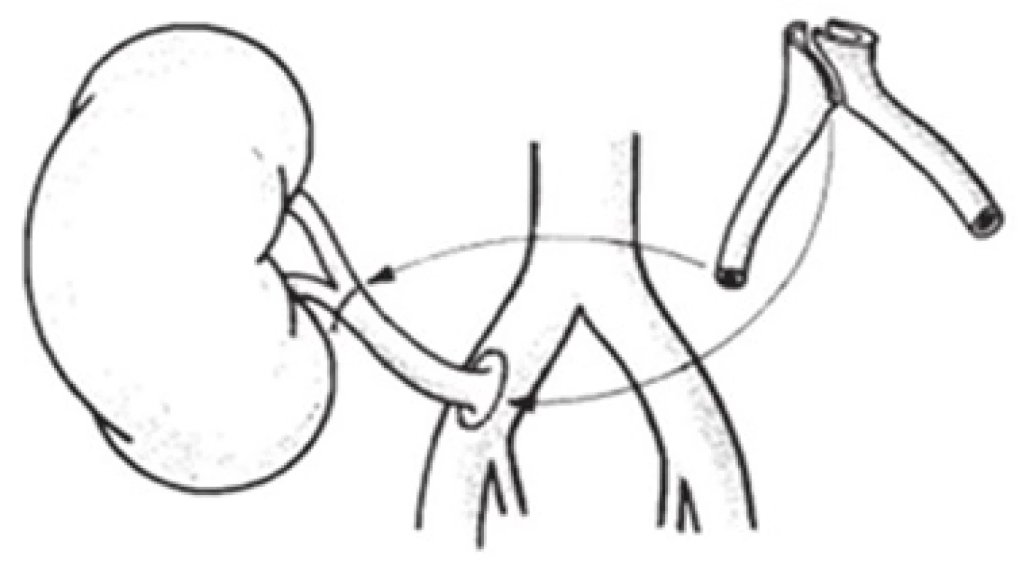 Predĺženie jednej renálnej artérie použitím darcovského vonkajšieho iliakálneho štepu [11]
Fig. 1: Extension of one renal artery using a donor external iliac graft [11]