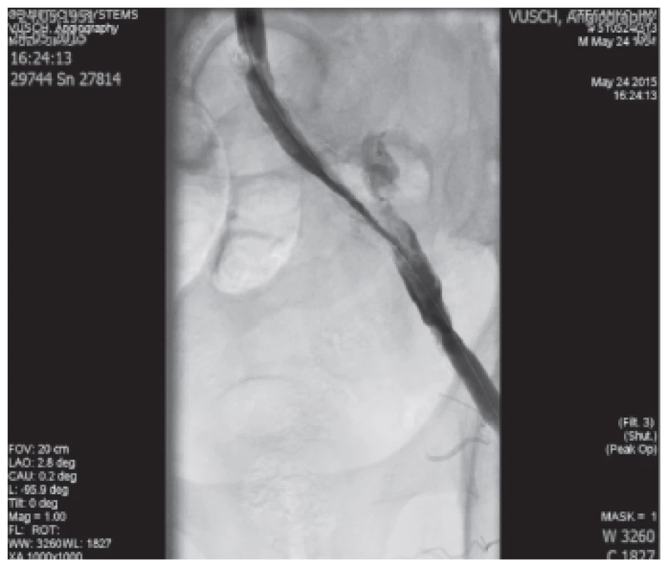 Trombus v a.iliaca externa l.sin.
Fig. 3: Trombus inside a. iliaca externa l.sin.