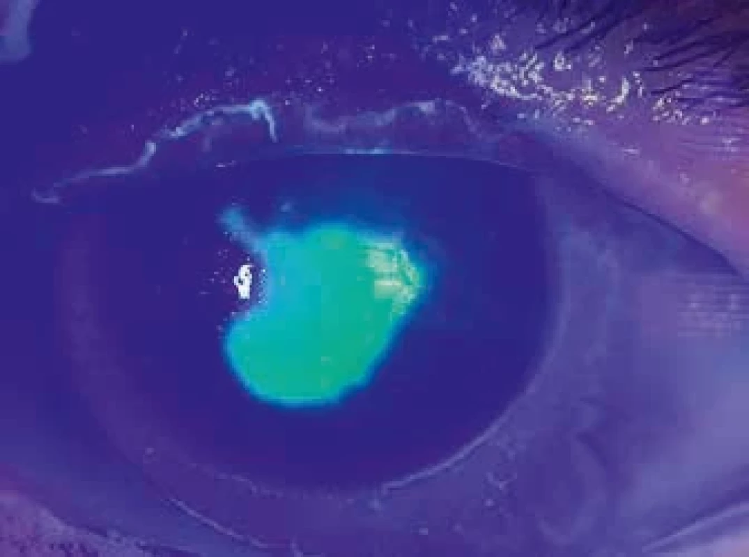 Eroze rohovky (po obarvení fluoresceinem v modrém kobaltovém světle). Corneal epithelial erosion observed under cobalt blue light after fluorescein staining.