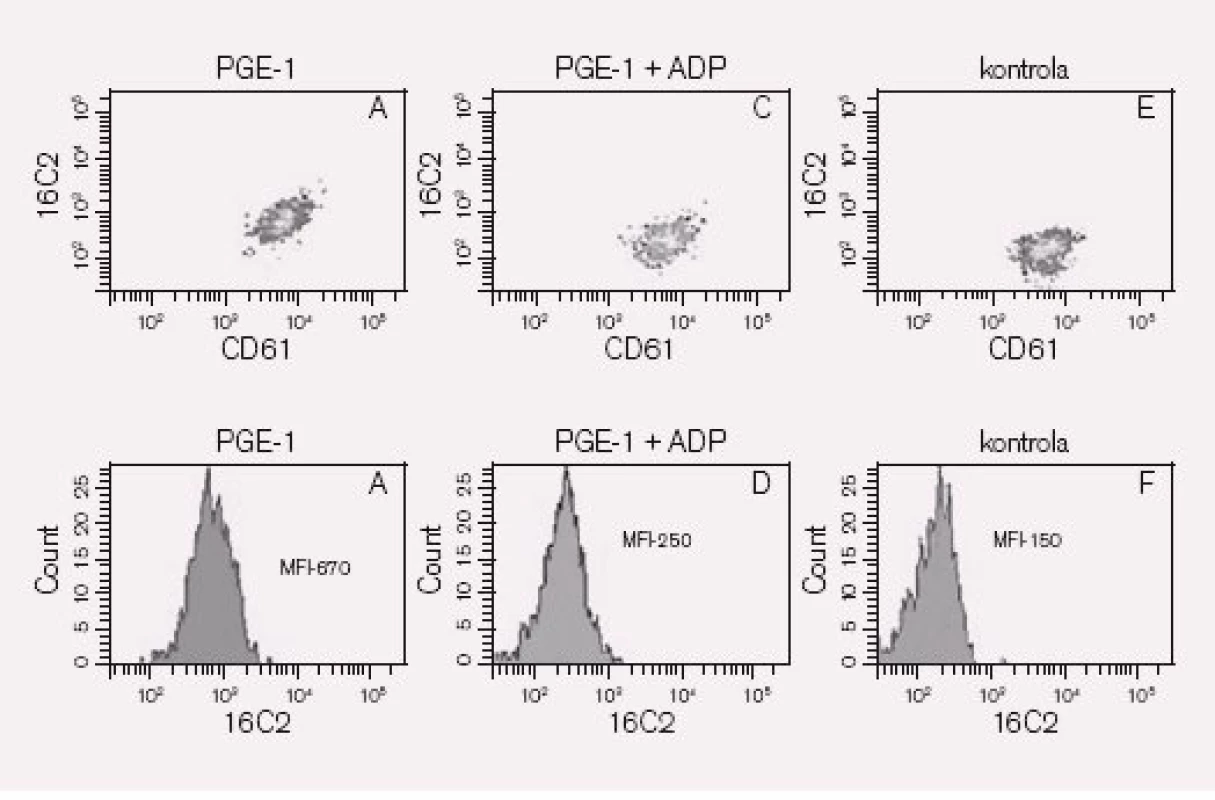 Výsledek vyšetření VASP. Trombocyty inkubujeme s PGE1 (A, B) a PGE1 + ADP (C,D). Fosforylaci VASP detekujeme po permeabilizaci trombocytů nepřímou fluorescencí za použití monoklonální protilátky <sub>-16</sub>C<sub>2</sub>. Stanovením PRI (Platelet Reactivity Index) podle vzorce PRI = [MFIc (PGE1) – MFIc (PGE1+ADP) / MFIc (PGE1)] × 100 hodnotíme kapacitu ADP blokovat VASP fosforylaci.