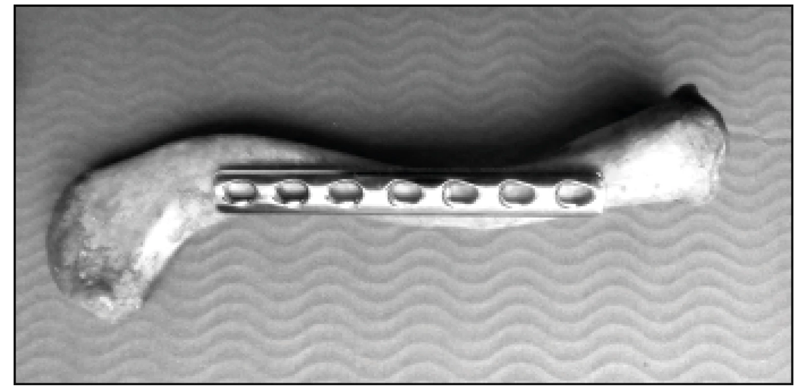 Možnosti přiložení 3.5 mm dlažek ke klíční kosti