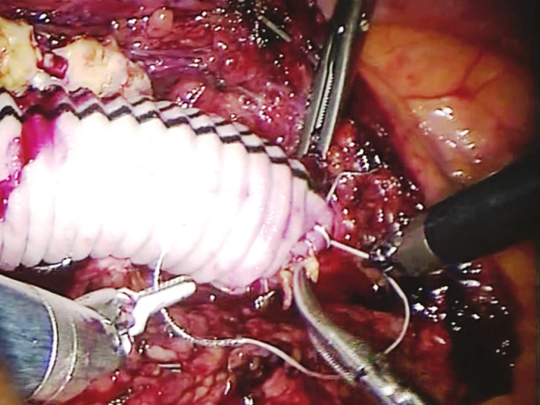 Centrální anastomóza AAA (end to end)
Fig. 5: The central end-to-end anastomosis of an AAA